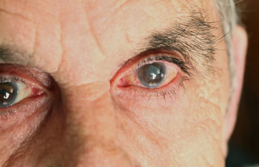 A Closer Look at Cataract Surgery